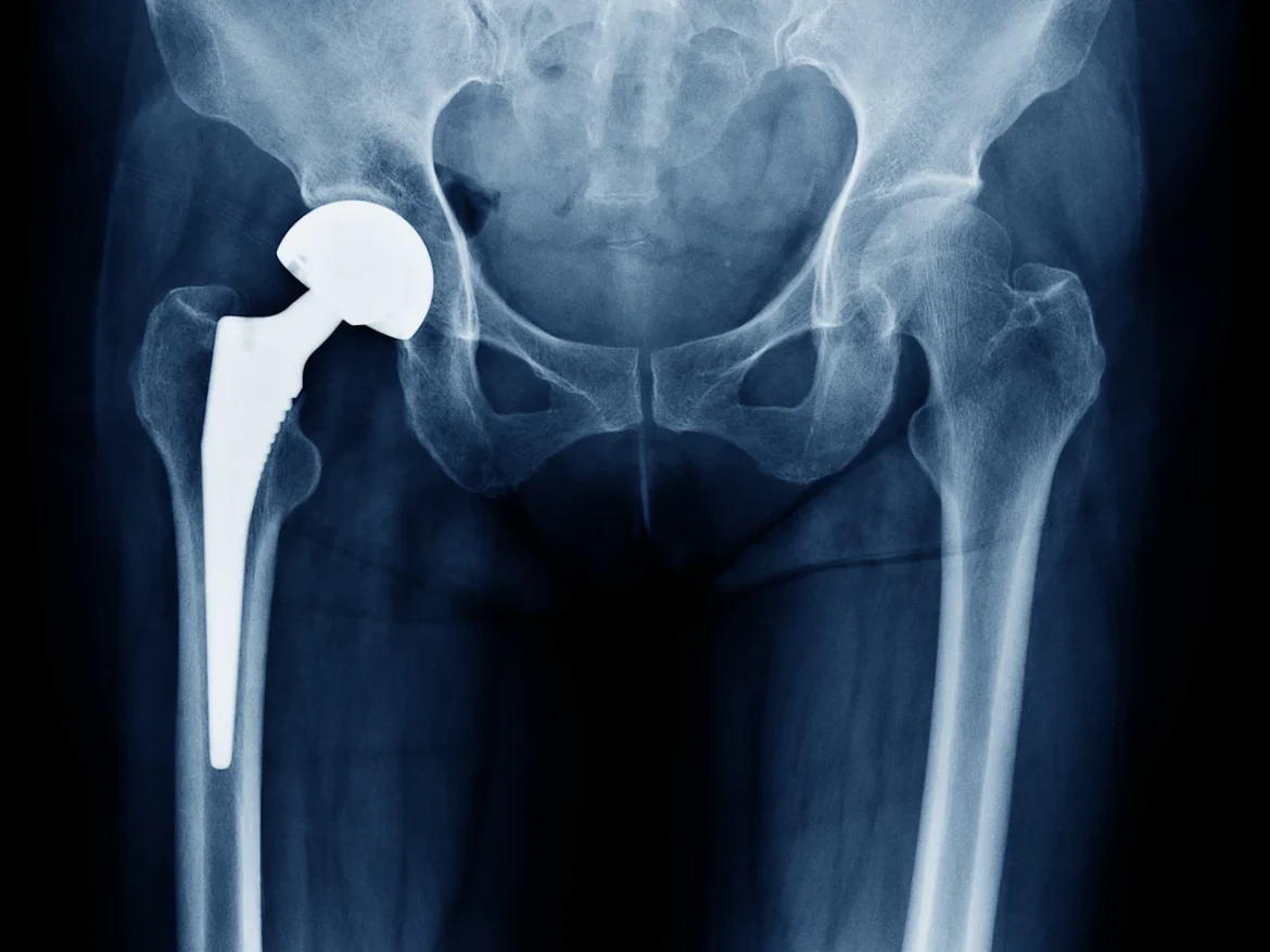 Exploring the Benefits of Hip Replacement Surgery