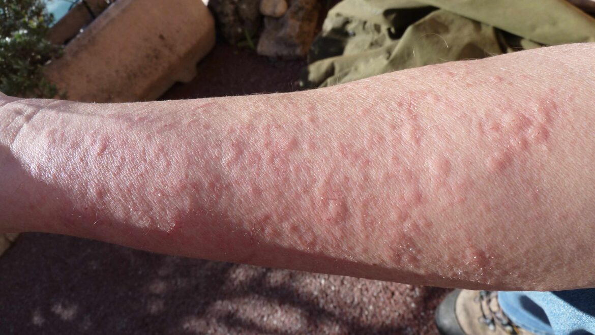 Home Remedies for Skin Allergies