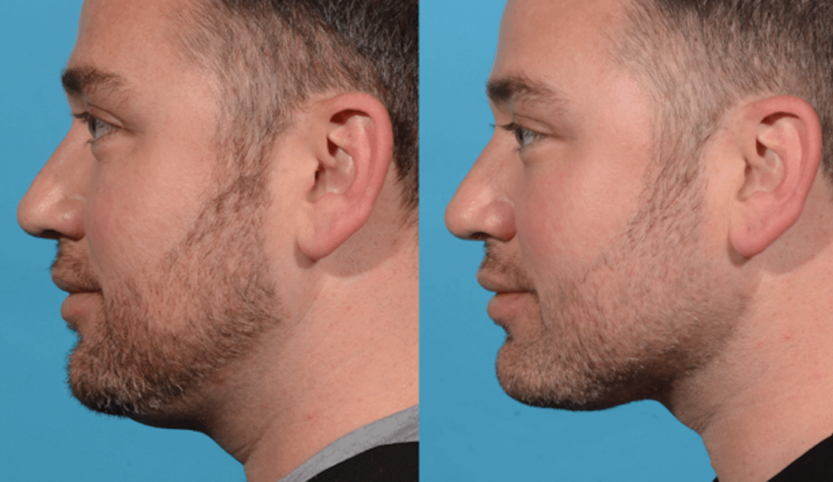 Benefits of Botox for Men