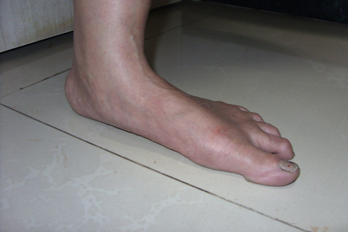 The Connection Between Flat Feet and Other Foot Problems
