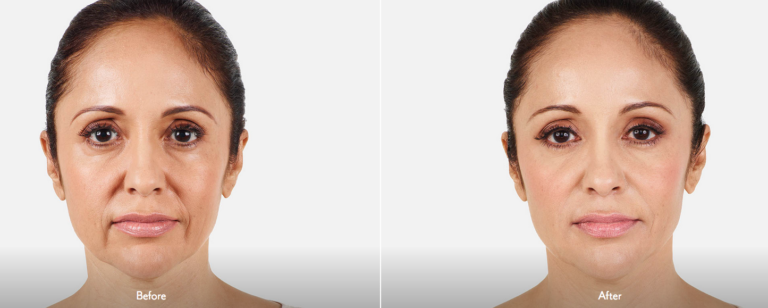 The Evolution of Dermal Fillers